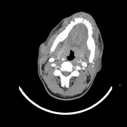 Basal Cell Adenoma Parotid Gland Radiology Case Radiopaedia Org