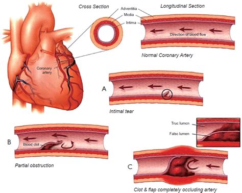 Spontaneous Coronary Artery Dissection Scad Saint Lukes Health System