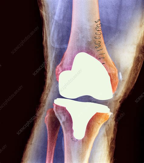 Knee Joint Prosthesis X Ray Stock Image M6000327 Science Photo