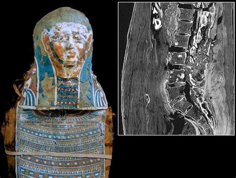 Prostate cancer tends to grow slowly compared with most other cancers. Mummy Had History's Second-Oldest Prostate Cancer Case | WIRED