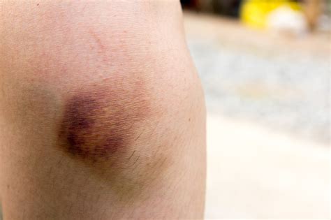 Brown Bruise On Woman Knee Background Stock Photo Download Image Now