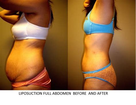 Smartlipo Laser Liposuction For Full Abdomen Before After Yelp
