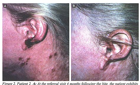 Figure 2 From Brown Recluse Spider Bites To The Head Three Cases And A