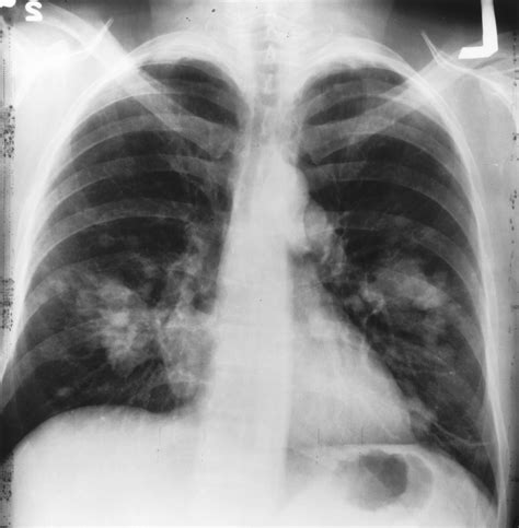 A tumor that is benign, it is not a health problem and it may not grow or change shape. File:Chest x-ray (cancer).jpg - Wikimedia Commons