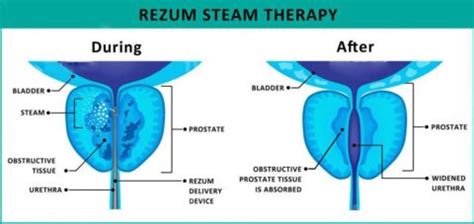 Rezum Steam Therapy For Enlarged Prostate Northern Beaches Urology