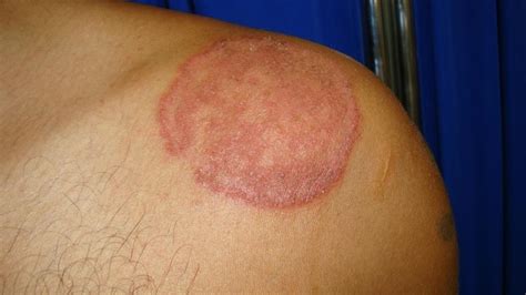 Ringworm Tinea Corporis Huidarts