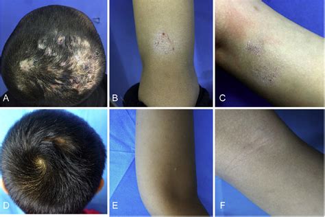 Infiltrating Erythema With Papulopustules Pustules Abscesses Hair