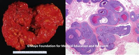 Ductal Carcinoma In Situ Of The Breast Mayo Clinic Proceedings