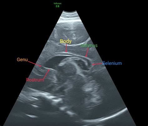 Agenesis Of Corpus Callosum Ultrasound