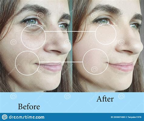 Woman Face Wrinkles Removal Care Regeneration Therapy Concept Collage