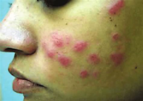 The Necessarily Intradermal Injection Of Silicone Into Acne Scars Led