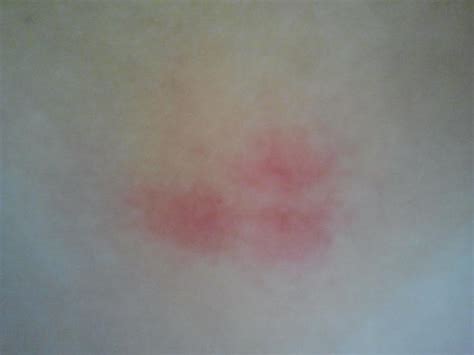 Eigene erfahrung max43326 05.07.2021, 19:23. Habe einen Zeckenbiss und Rötungen. Habe ich Borreliose ...