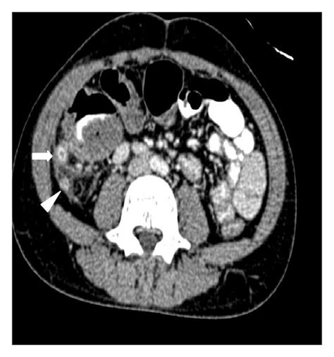 Contrast Enhanced Ct Showing Long Inflamed And Retrocaecal Appendix