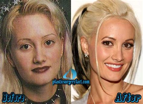 Holly Madison Plastic Surgery Before And After Photos Plastic Surgery