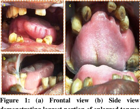 Tongue Crenation Scalloped Tongue Case Report Semantic Scholar