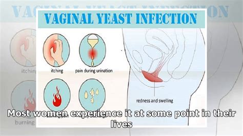 Vaginal Itching Causes Symptoms Home Remedies And Treatment Youtube