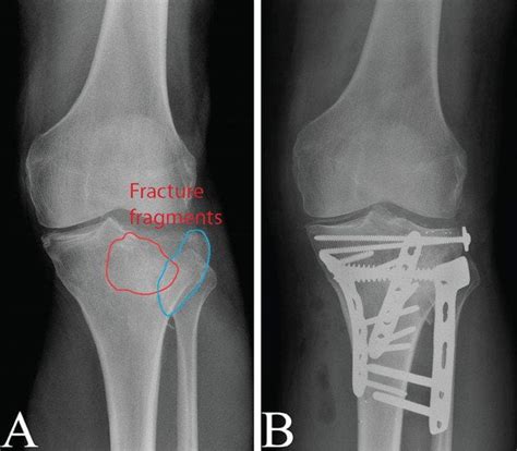 How Long Does Swelling Last After Tibial Plateau Fracture
