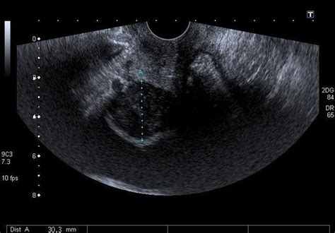An Unusual Presentation Of A Vaginal Leiomyoma In A Postmenopausal Hysterectomised Woman A Case