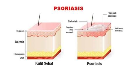 Penyakit Psoriasis Info Seputar Peradangan Kronis Di Kulit •