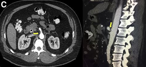 A Rare Cause Of Post Sphincterotomy Bleeding Gastroenterology