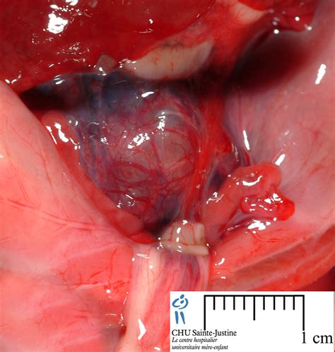 What is pms and how does it affect you physically and psychologically, and what it takes to get diagnosed. Case #11184 - Renal hypodysplasia with bifid uterus and ...