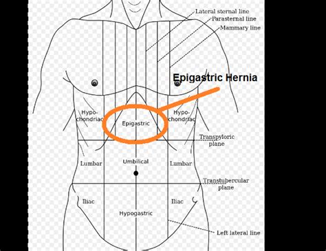 What Is Epigastric Hernia Swami Dayanand Naturopathy Hospital