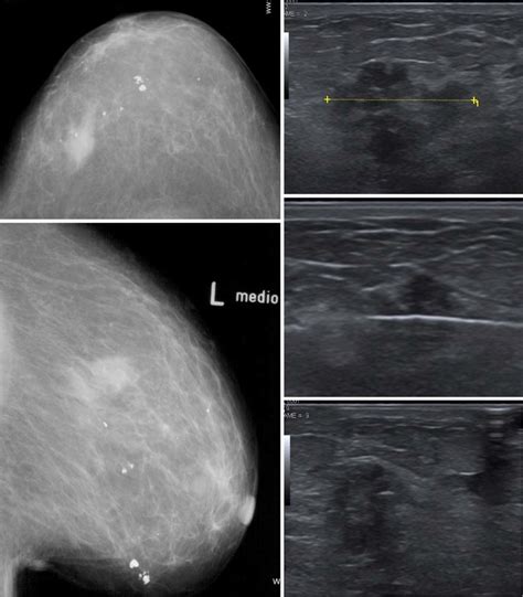 Abnormal Screening Mammography Of A 65 Year Old Asymptomatic Woman