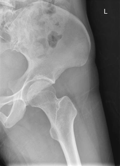 Normal X Ray Left Hip Lateral View Download Scientific Diagram