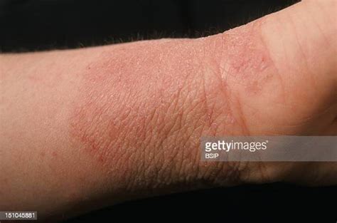 Contact Dermatitis Photos And Premium High Res Pictures Getty Images