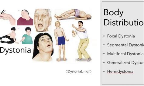 Dystonia niekontrolowane skurcze grup mięśniowych co to jest Przyczyny Objawy diagnostyka