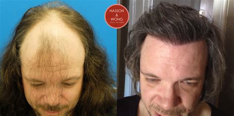 Shock loss caused by trauma of a hair transplant, causing native hairs to temporarily shed. Hair Transplant Result