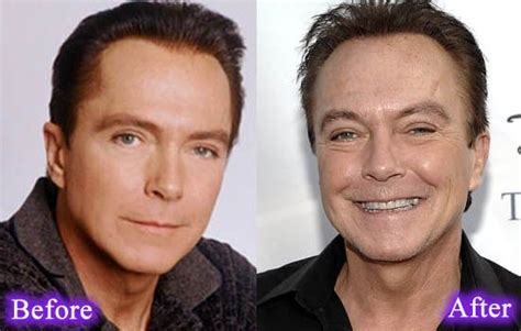 Image Result For David Cassidy Plastic Surgery David Cassidy Plastic