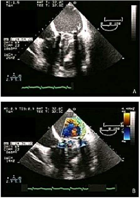 A Valve Dehiscence In A Prosthetic Mitral Valve Arrow B Double