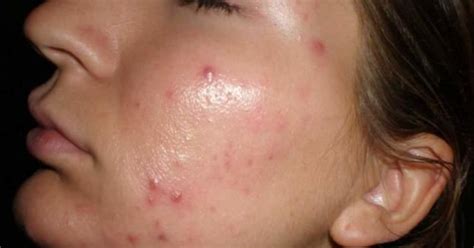 Do You Notice Mild Acne Does It Gross You Out Or Does Only Severe