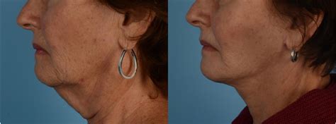 facelift neck lift before and after pictures case 244 toronto on ford plastic surgery dr