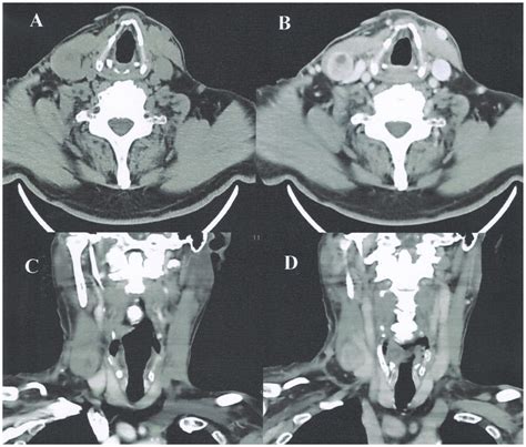 A And C Ct Scan Showing An Uneven Density Soft Tissue Masses In The