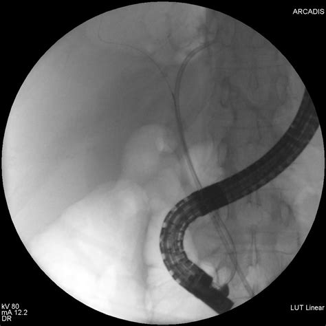 Hilar Cholangiocarcinoma Endoscopic Prosthesis By Ercp Gastrocloud