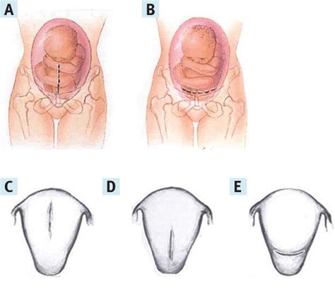 Cesarean Section Anatomy Layers Anatomical Charts Posters Sexiezpicz