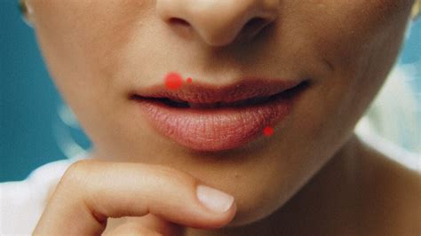 Cold Sore Vs Pimple How To Prevent Treat And Tell The Difference