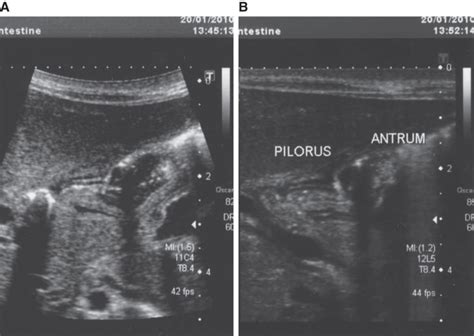 Longitudinal Ultrasound Image Of Pylorus And Antrum Performed On Day 58