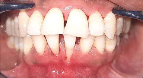 Treatment Of Aggressive Periodontitis With Photodynamic Therapy And