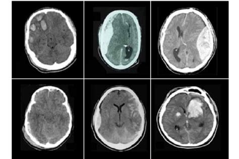 Lesiones Primarias A Contusiones Cerebrales B Hematoma Subdural