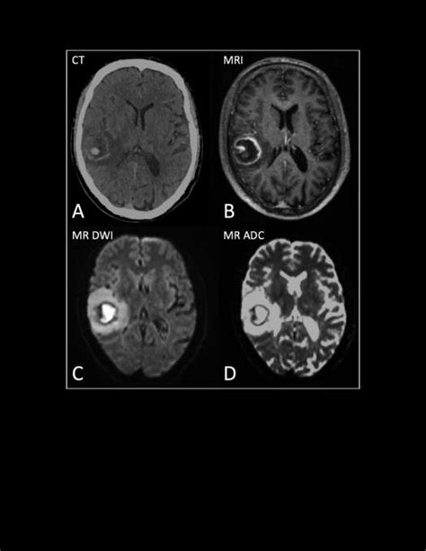 A Contrast Enhanced Computed Tomography Ct Scan And B