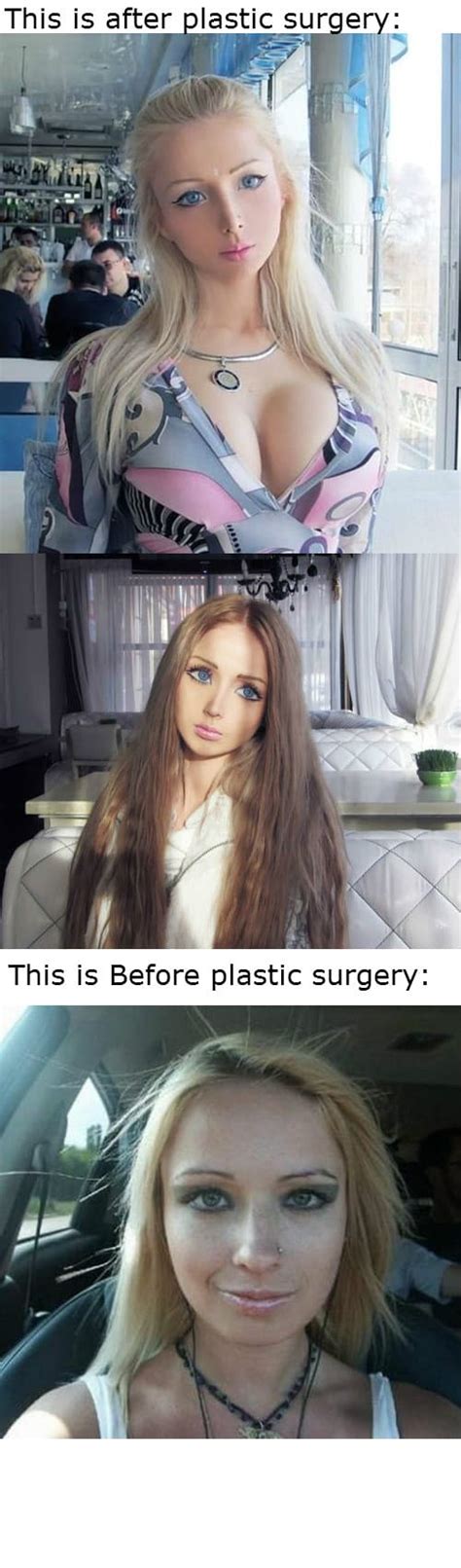 Living Barbie Before And After Plastic Surgery
