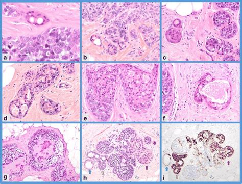 Invasive Breast Carcinomas Showing Eccrine Ductal And Acrosyringeal