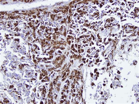 A The Histopathologic Findings Of The Bluish Black Ulcerative Nodule