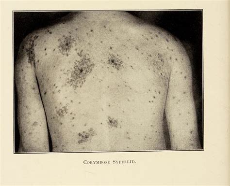 This Image Is Taken From Page 802 Of Diseases Of The Skin  Flickr