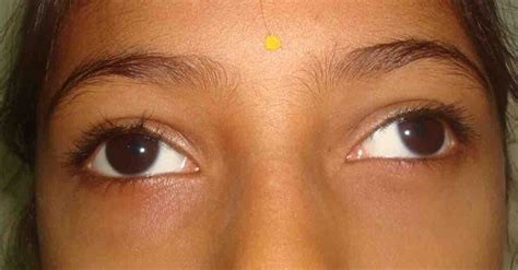 Best Squint Specialist In Mumbai India Dr Anand Kumar Utsav Eye Clinic