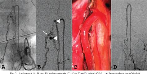 Figure 2 From Successful Management Of An Anterior Thoracic Type IV