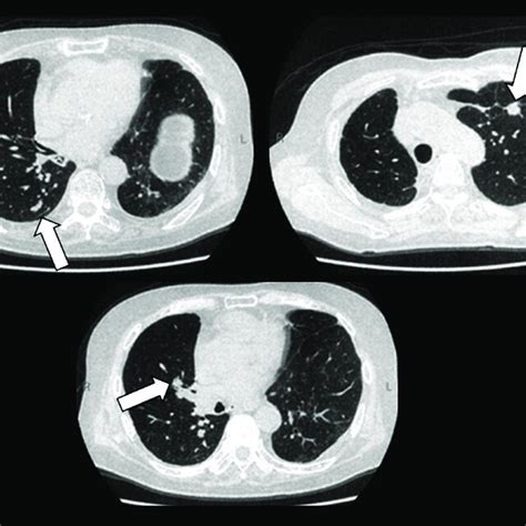 The Final Recurring Multiple Metastatic Lung Cancers In Both Lungs